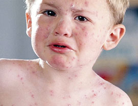 Епідемія кору загрожує Буковині, в лікарні є вакцина від хвороби
